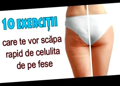 cellulitisz