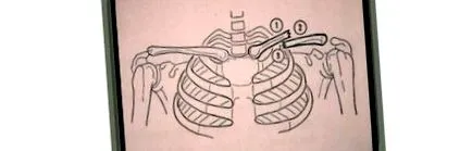 apollus törés