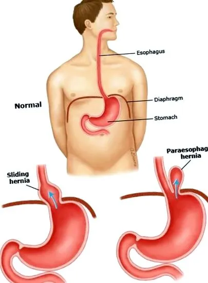 hiatal sérv hiatal sérv
