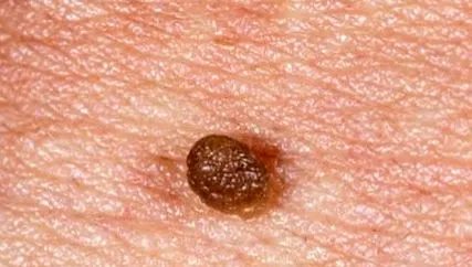 lesion