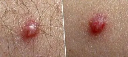 humani papiloma zena