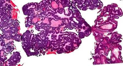 papilloma