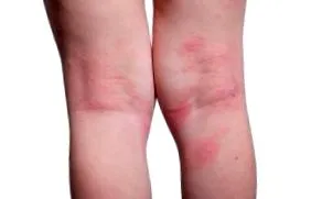 psoriasis