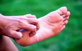 psoriasis
