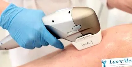 HIFU technológiával