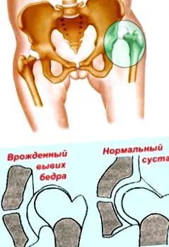 біль вивих
