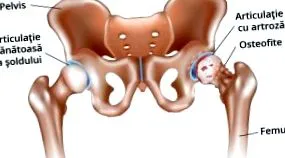 csípőízület osteoarthritisének