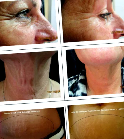 dermapennel