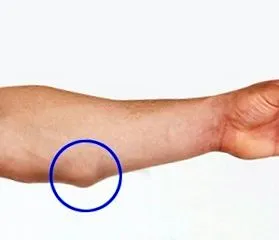 csomók vagy