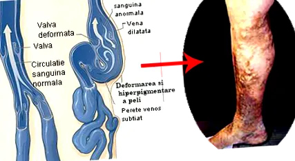 klinika visszérműtét