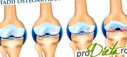 osteoarthritis