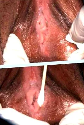 papilloma papillomavírus