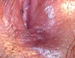 papilloma