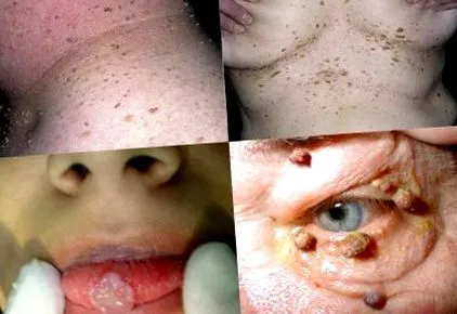 papilloma