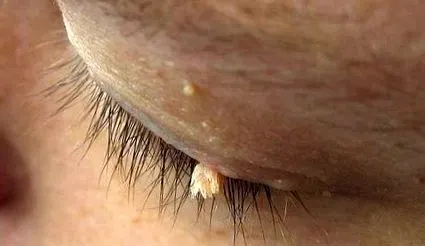 papilloma