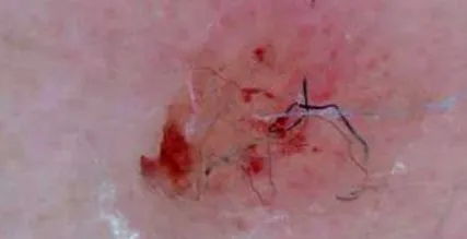 fogyásban morgellons