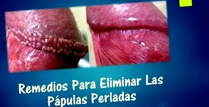 papilloma konizációja