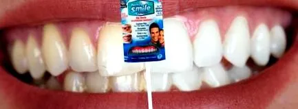 veneers
