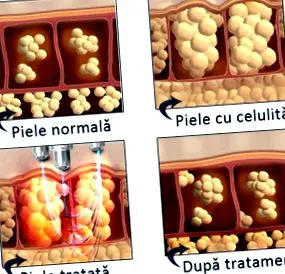 virtuális mezoterápia