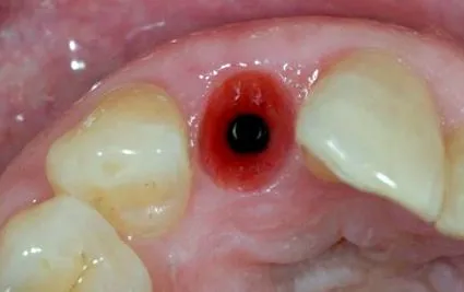 implantátumok