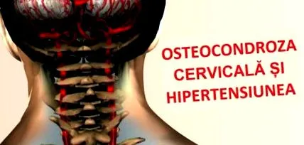 засоби остеохондрозу