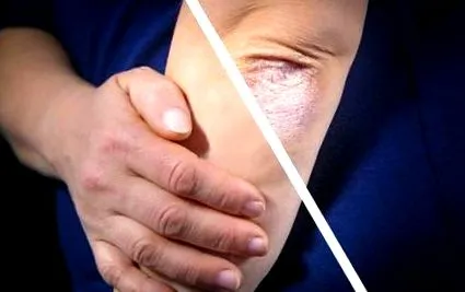 solară psoriazis