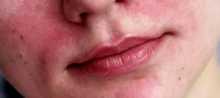 technikája nasolabialis