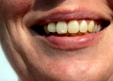príznaky