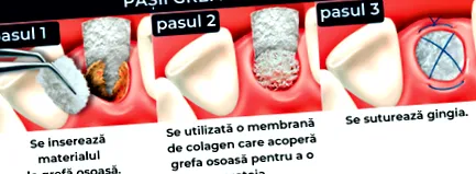 csontadagolás