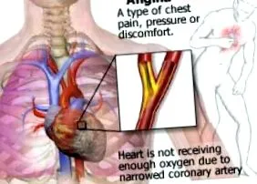 angina