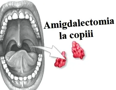 mandulagyulladás