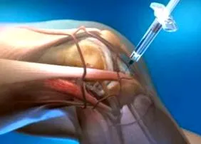 kezelési osteoarthritisje
