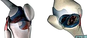 osteoartróza
