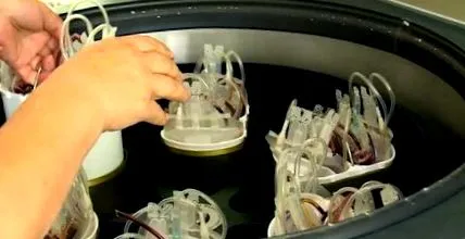 autotranszfúzió eljárás
