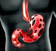 reflux