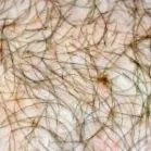 crisderma
