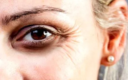 botulinum toxin