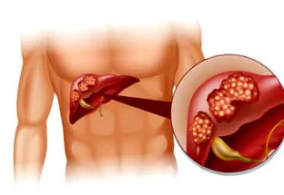 patogenezis