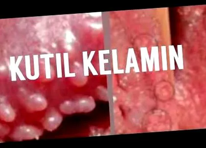 menghilangkan