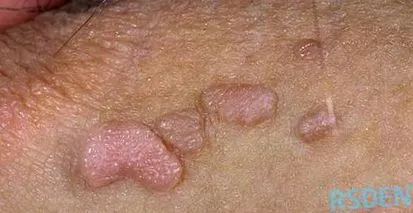 emberi papilloma