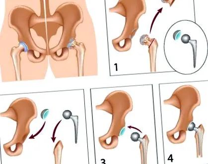 csípőízület osteoarthritisének