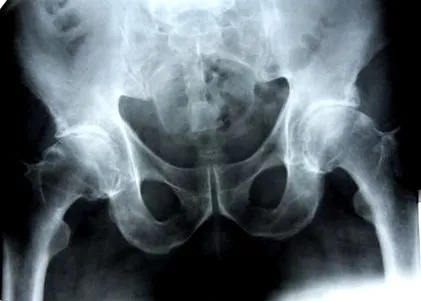 csípőízület osteoarthritisének