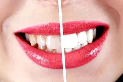 bahdental albirea