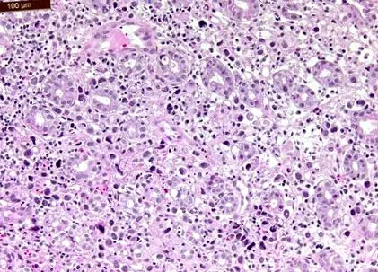 adenomatózus daganatok