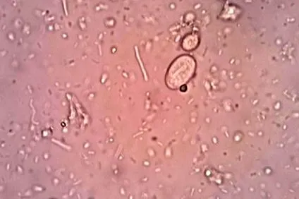 giardiasis