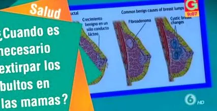 giardiasis