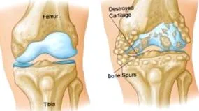 gonarthrosis