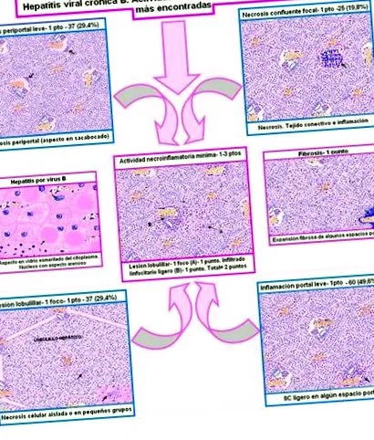 hepatitis hepatitis
