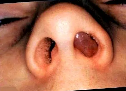 papilloma papilloma