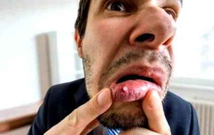 herpes simplex